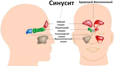 Рентген и КТ гайморовых пазух носа: что показывает, гайморит на снимке