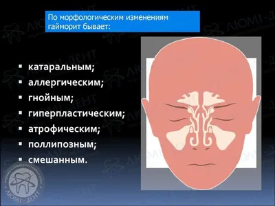 CLDH: Эндоскопическая гайморотомия. Клинический случай