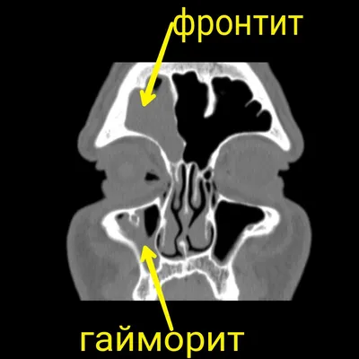 Неинвазивный грибковый синусит | Радиография