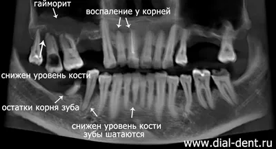 Гайморит От Зуба 9 Фото Что Это Такое Как Лечить ЛюмиДент