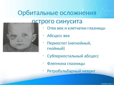 Одонтогенный гайморит. От зубного до лора – клиника «Семейный доктор».