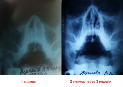 Гайморит, Фронтит, рентгент снимок прилагаю | Портал радиологов