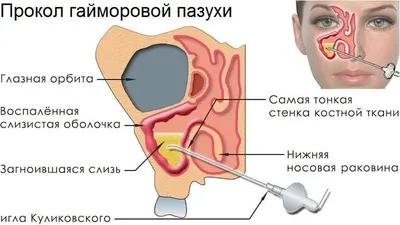 ▷ Синусит (воспалений пазух носа): симптомы, причины и лечение