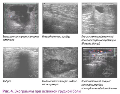 Гамартома | MyPathologyReport.ca