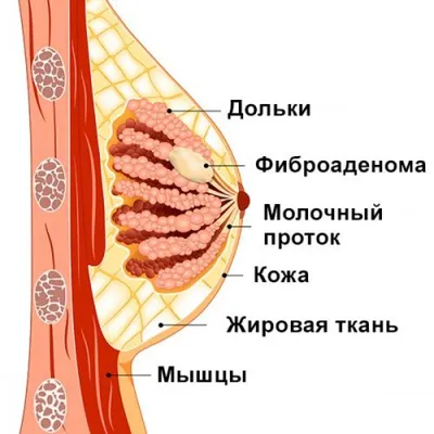 УЗИ молочной железы у детей (лекция на Диагностере) - Диагностер