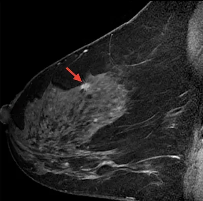 A 50-year-old woman with left breast lump for 8 months. Mammography:... |  Download Scientific Diagram