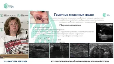 Гамартома молочной железы: диагностика, симптомы, лечение