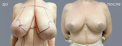 mammogramma