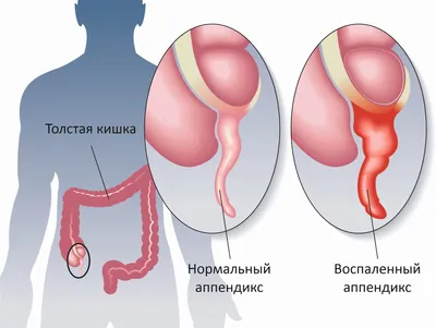 Где находится аппендицит картинка фотографии