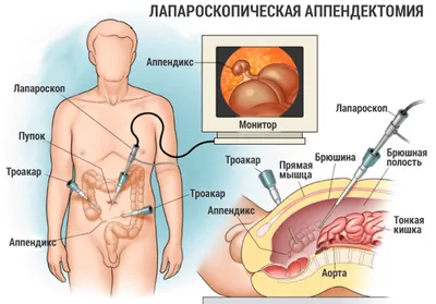 Аппендицит – это... - Стоматологическая клиника Демостом | Facebook