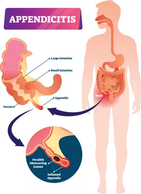 Как понять, что у Вас аппендицит, и ненадолго облегчить состояние -  Гастроцентр