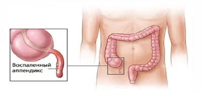 Острый аппендицит: симптомы, диагностика и лечение в Москве — цены и запись  на диагностику онлайн в Европейском Медицинском Центре EMC