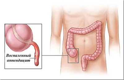 Как распознать аппендицит