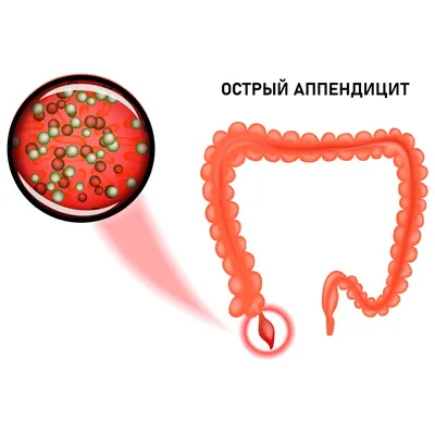 Аппендицит Острый Желудок Находится На Теле Женщины Серый Фон Анатомия  Концепции — стоковые фотографии и другие картинки Антисанитарный - iStock