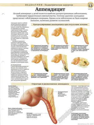 Аппендицит у взрослых: причины, симптомы, лечение, профилактика в домашних  условиях