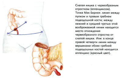 Операция на удаление паховой грыжи у мужчин и женщин: реабилитация,  лечение, сколько длится и как делают операцию