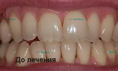 Реминерализирующее покрытие зубов в стоматологии Бэбибум в Оренбурге