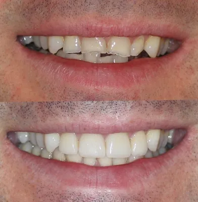 Восстановление эмали зубов — способы и цены