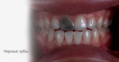 Черные зубы [как лечить и почему зуб внутри черный]