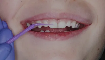 ᐈ Фторирование молочных зубов в Запорожье • Реминерализация зубов у детей •  Цена ⇒ Nikolov Dental Clinic