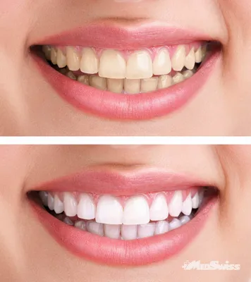 Отбеливание зубов - Косметология Medswiss