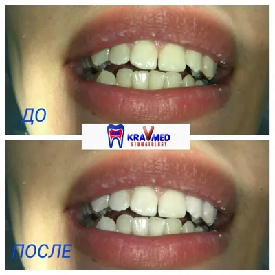 Эстетическая реставрация зубов • Имплантация и протезирование зубов  Волгоград