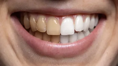 Глубокое фторирование зубов что за процедура