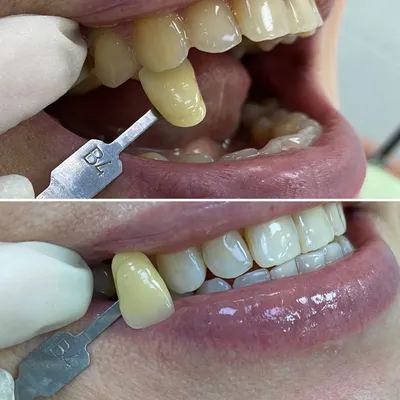 Ультразвуковая профессиональная гигиеническая чистка зубов в СПб от зубного  камня