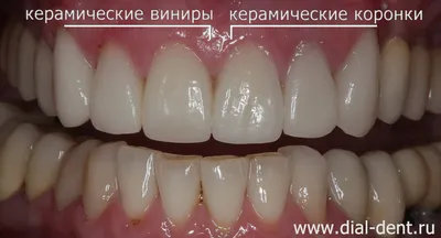 Гель стоматологический GC Tooth Mousse реминерализирующий эмаль зубов -  «Гель который может предотвратить пришеечный кариес, истончение эмали. Фото  зубов» | отзывы