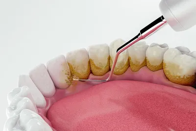 Профессиональное отбеливание зубов – стоматология ПрезиДЕНТ