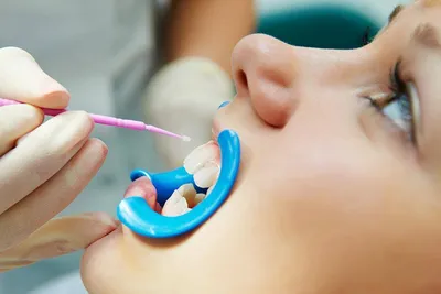 Методы лечения кариеса - детская стоматология \"Рудента\"