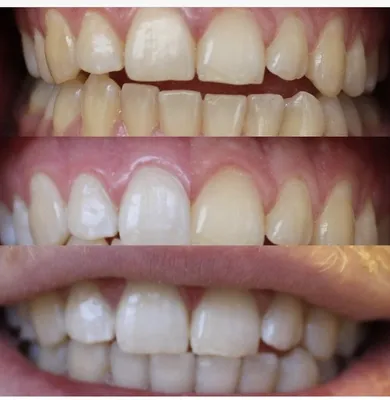 Из-за чего чернеют зубы или темнеет эмаль? | Центр имплантации Доктора  Федорова | Дзен