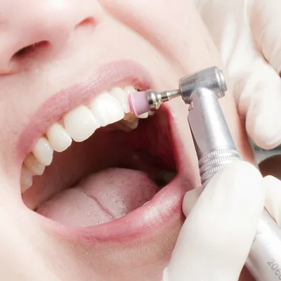 Можно ли поставить виниры без обточки зубов – особенности протезирования с  сохранением зубной эмали