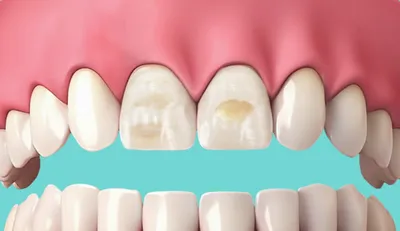 На сколько тонов можно отбелить зубы? Ответ стоматолога