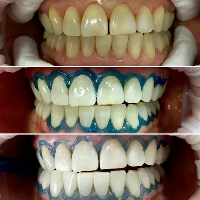 Накладки на зубы: цены и виды зубных накладок на передние зубы в  стоматологии Estetica Dent
