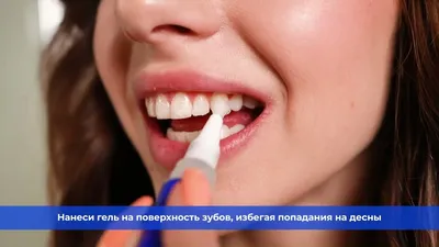 Лечение кариеса ICON - цена в Москве, лечение кариеса без сверления зубов