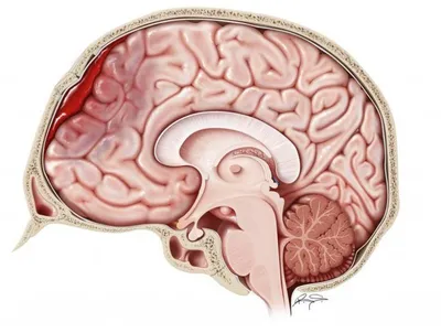 Симптомы и лечение внутримозговых гематом и ушибов | Отделение  нейрохирургии ГКБ им. А. К. Ерамишанцева (ГКБ №20)