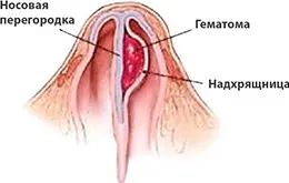 Субдуральная гематома