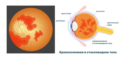 Ирина• неонатолог •о чем [не]молчат в материнстве🫰 on Instagram:  \"КЕФАЛОГЕМАТОМА, что это? К сожалению, не всегда роды проходят без  последствий и гладко, и почти у 3% рождённых деток есть такая родовая  травма,