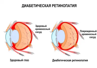 В отделении нейрохирургии была успешно проведена редкая операция:  Эндоскопическое удаление хронической субдуральной гематомы | Городская  клиническая больница им. В. М. Буянова