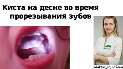 Гематома на десне у новорождённых во время прорезывания зубов.Она опасна? -  YouTube