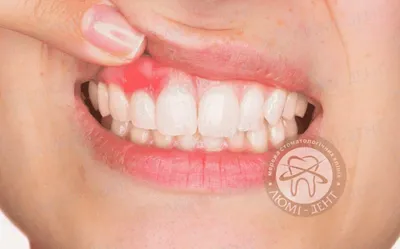 Елена Сумбаева on Instagram: \"СИНЯК,СИНЯЧОК,КИСТА ИЛИ ГЕМАТОМА. СТАВИМ❤  Одним из самых важных периодов в развитии детского 👶👦👧организма является  формирование челюстно-лицевой системы, что также включает в себя прорезывание  зубов, как молочных, так и