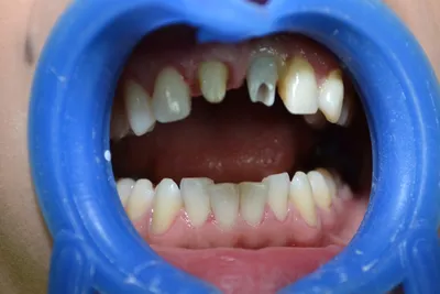 Прорезывания зубов у детей, последовательность, сроки, симптомы