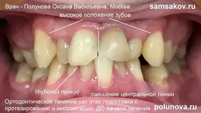 Гематома в стоматологии: симптомы, лечение и причины