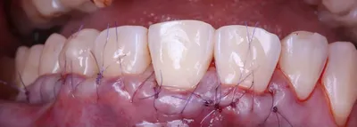 Как облегчить прорезывание зубов ребенку?