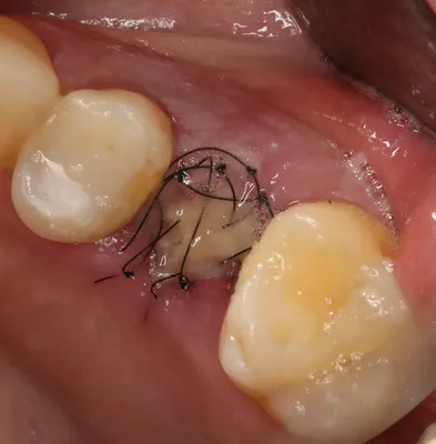 Гемостатическая губка в стоматологии