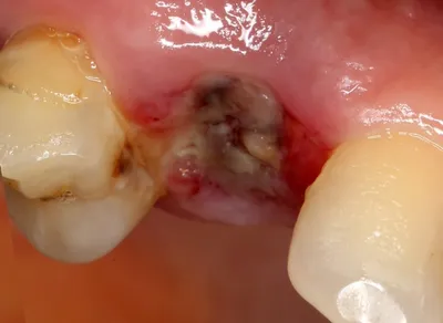 После удаления зубов в лунках оставляют какие-то тампончики? и когда их  вытаскивать? - Хирургическая стоматология - Стоматология для всех