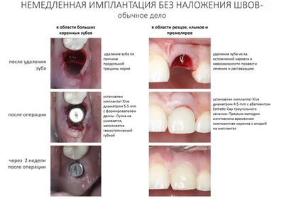 Сукровица после удаления зуба: первая помощь
