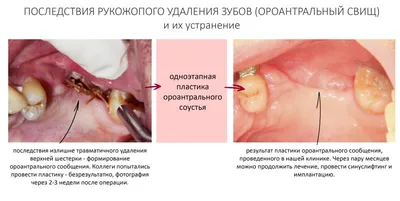Альвостаз (губка) антисептик для альвеол с йодоформом, 30 шт. | Купить  стоматологические товары недорого в интернет-магазине Dental First
