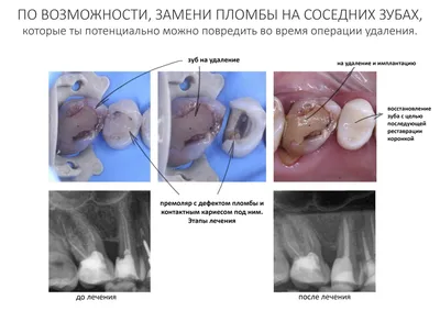 Немедленная имплантация в области многокорневых зубов | Имплантариум  Немедленная имплантация в области многокорневых зубов